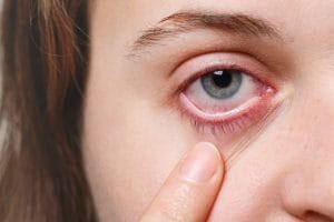 Göz enfeksiyonu nedir, belirtileri nelerdir, nasıl geçer?