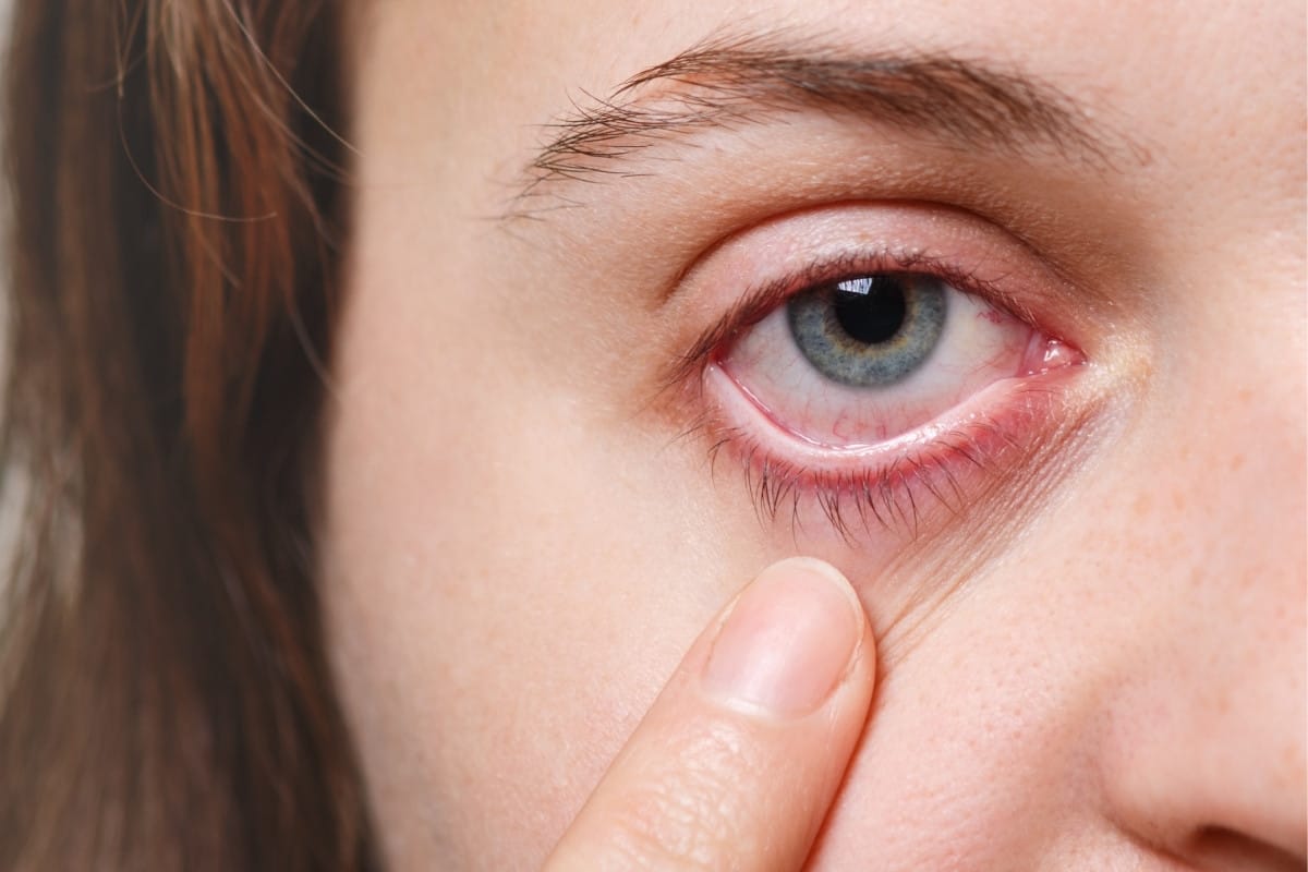 Göz enfeksiyonu nedir, belirtileri nelerdir, nasıl geçer?