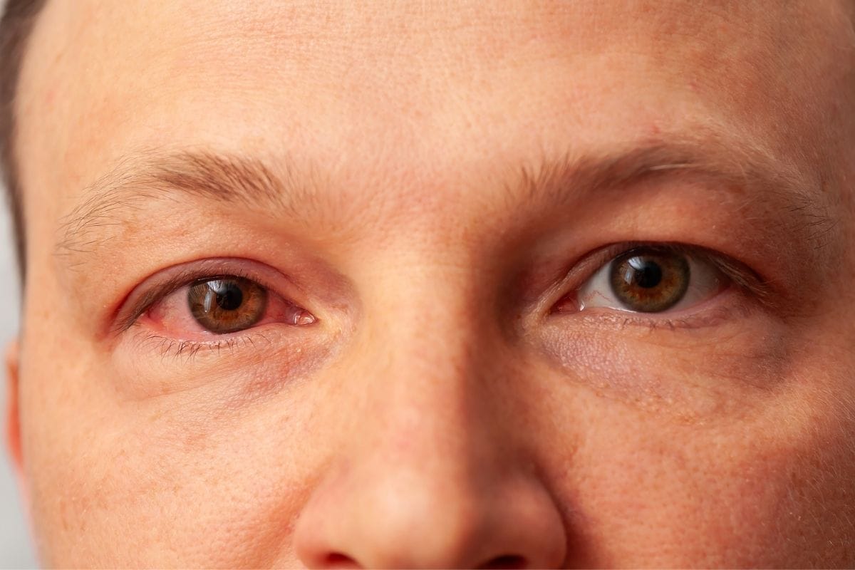 Göz nezlesi nedir, belirtileri nelerdir?