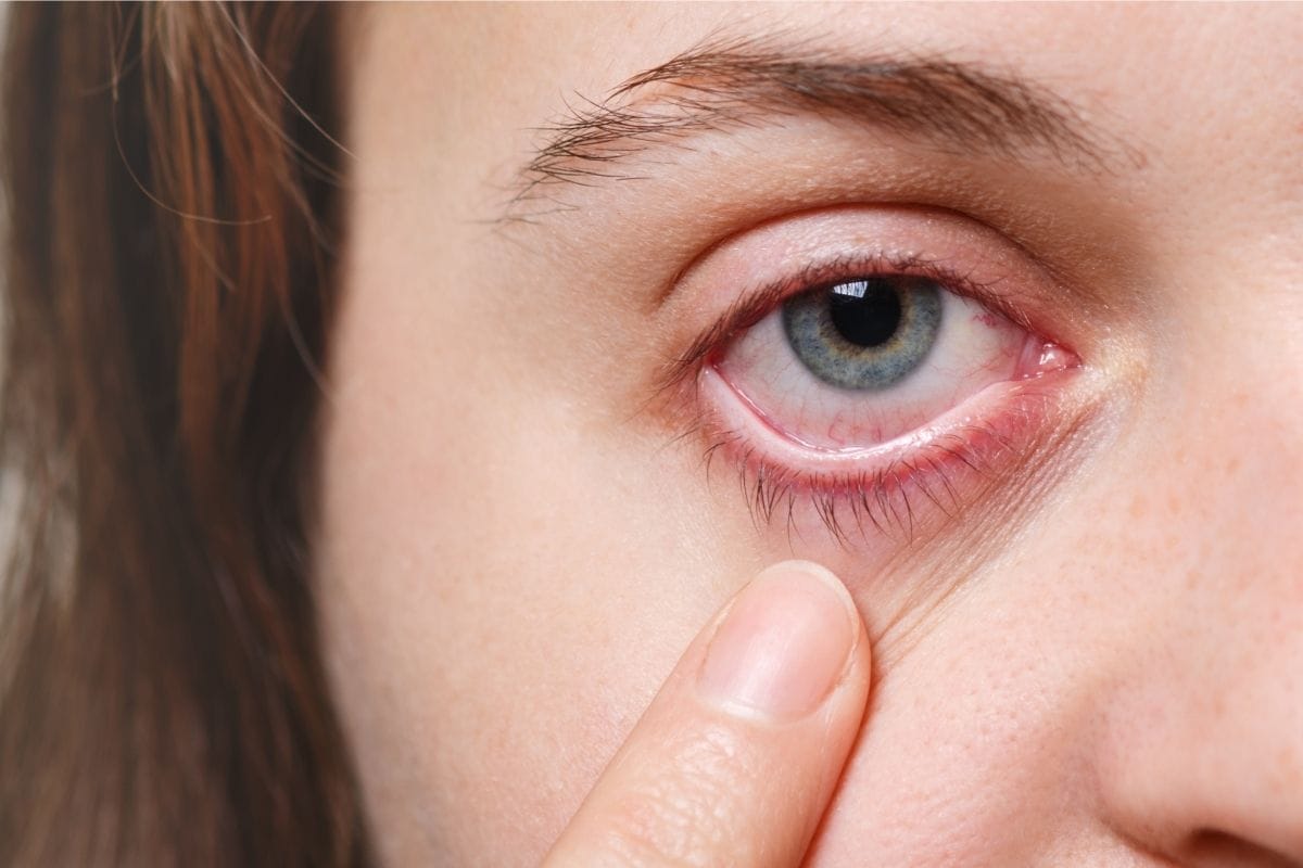 Adenoviral konjonktivit nedir? Belirtileri ve tedavisi