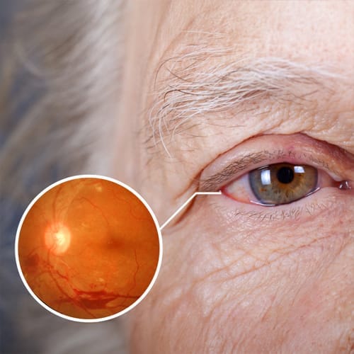 Diyabetik-Retinopati.jpg